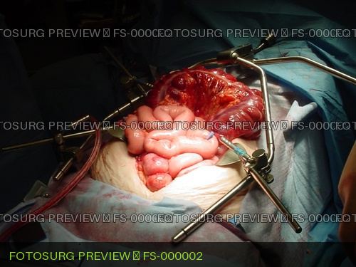Toxic megacolon