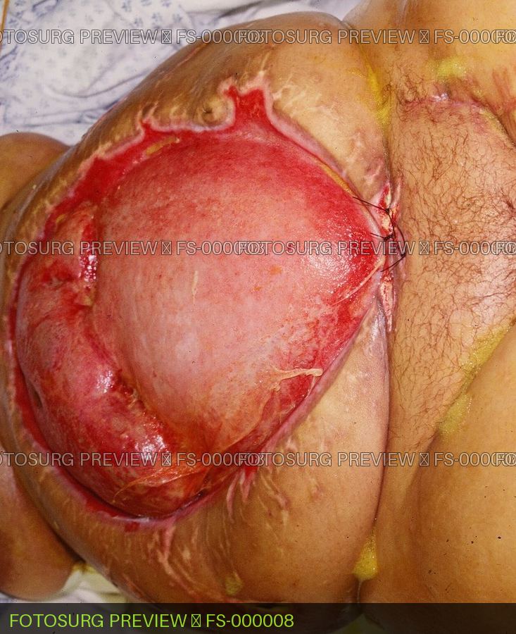 Open Abdomen Graft Ready