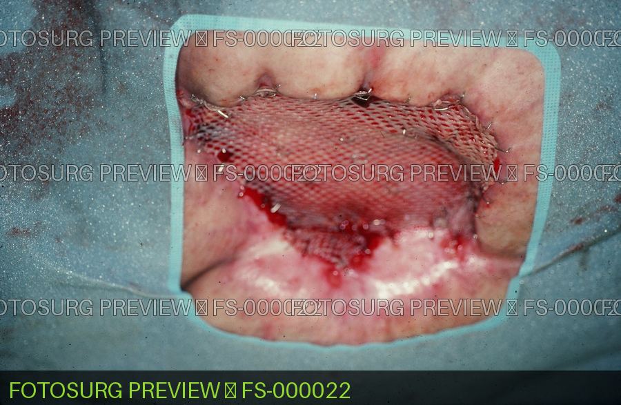 Split thickness skin graft