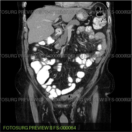 Duodenal perforation