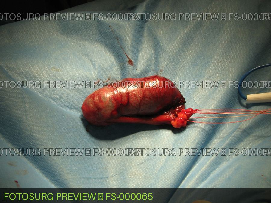 Appendiceal mucocele