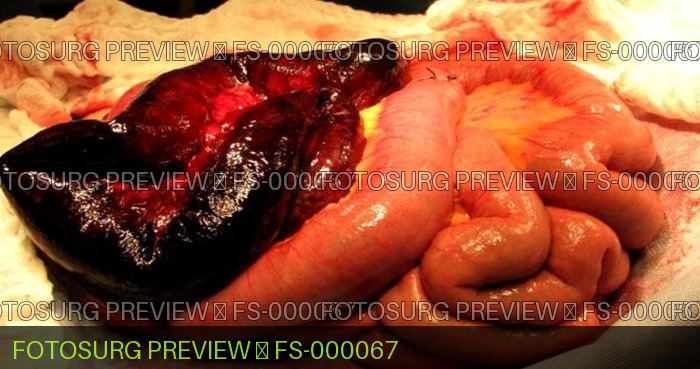Strangulated Small Bowel