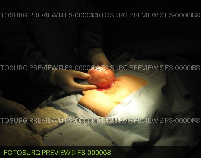 Umbilical Hernia open