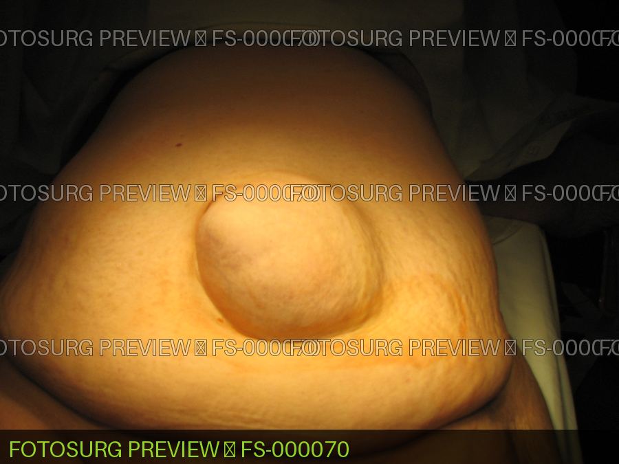 Large Umbilical Hernia
