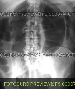 Sigmoid volvulus