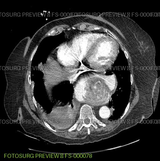Paraesophageal hernia with Gastric volvulus