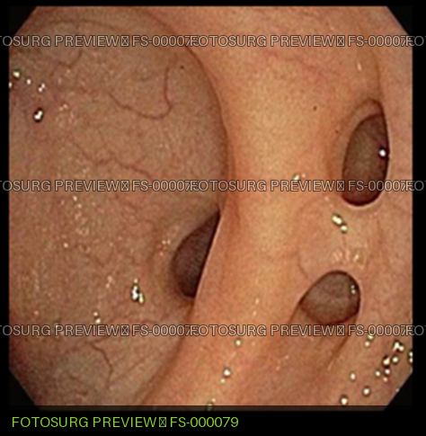 Diverticula Disease