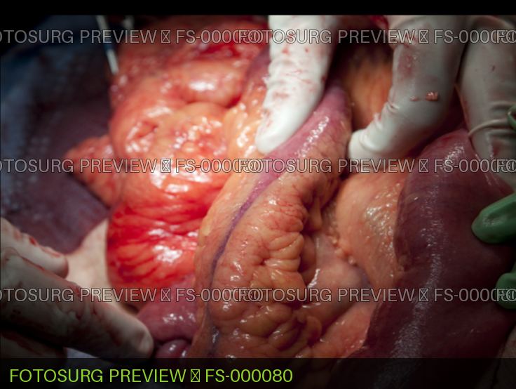 Small Bowel Stricture from Crohn's
