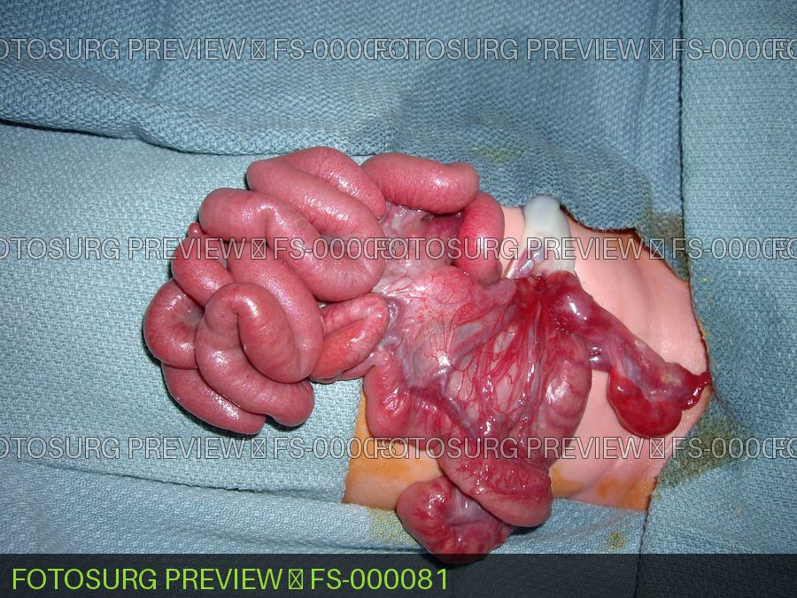 Gastroschisis