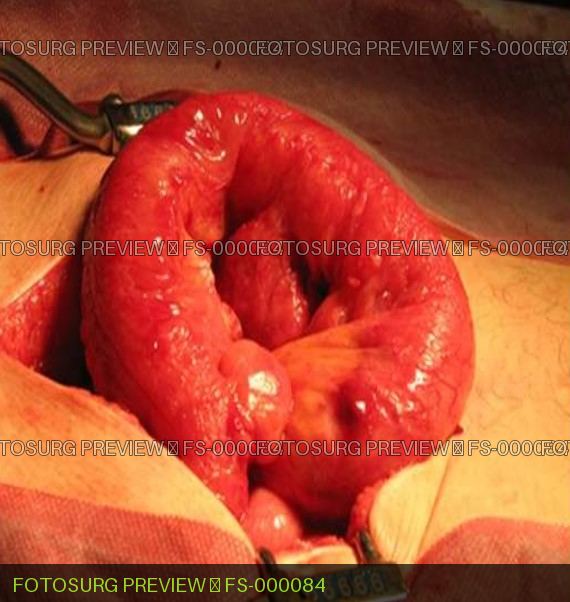 Small Bowel Diverticulitis