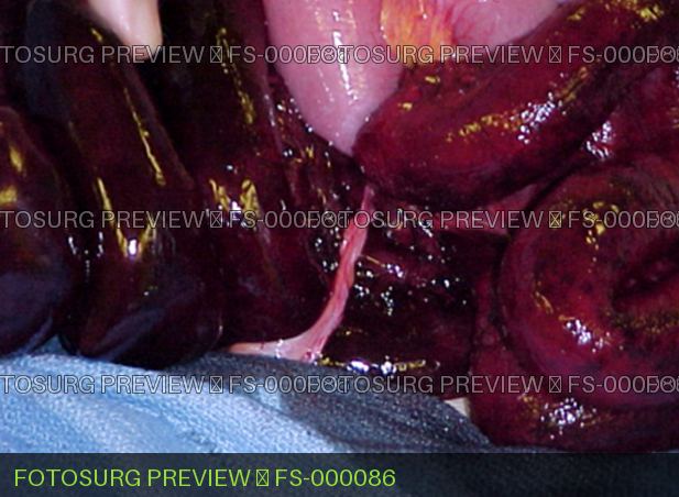 Small Bowel Adhesive Band/Bowel obstruction , Bowel ischemia