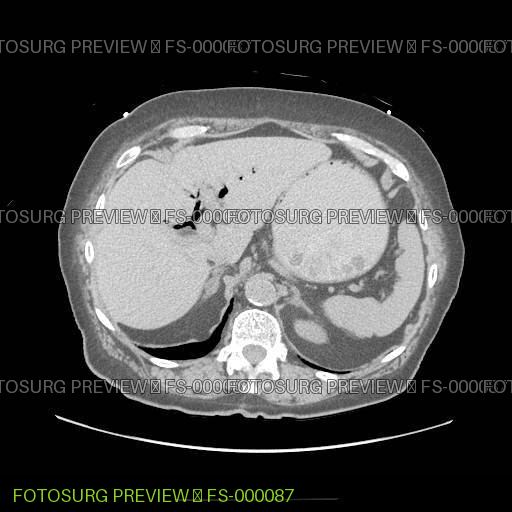 Portal venous gas