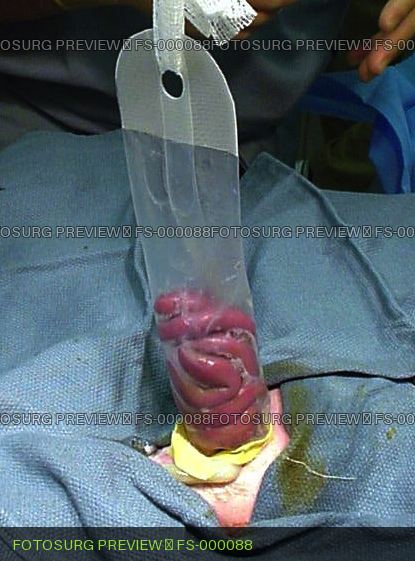 Silo Bag