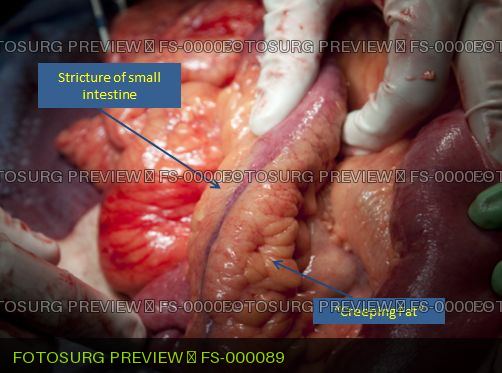 Crohns stricture
