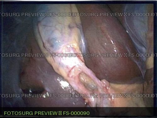 Gallbladder