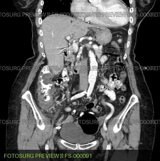 Right colon mass