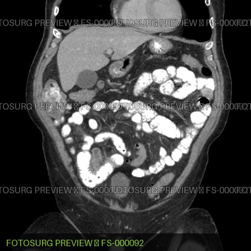 Meckel diverticulitis