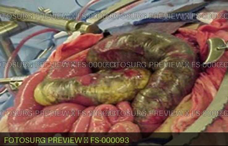 Bowel Ischemia