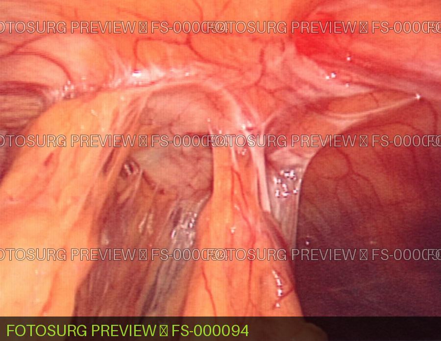 Adhesions