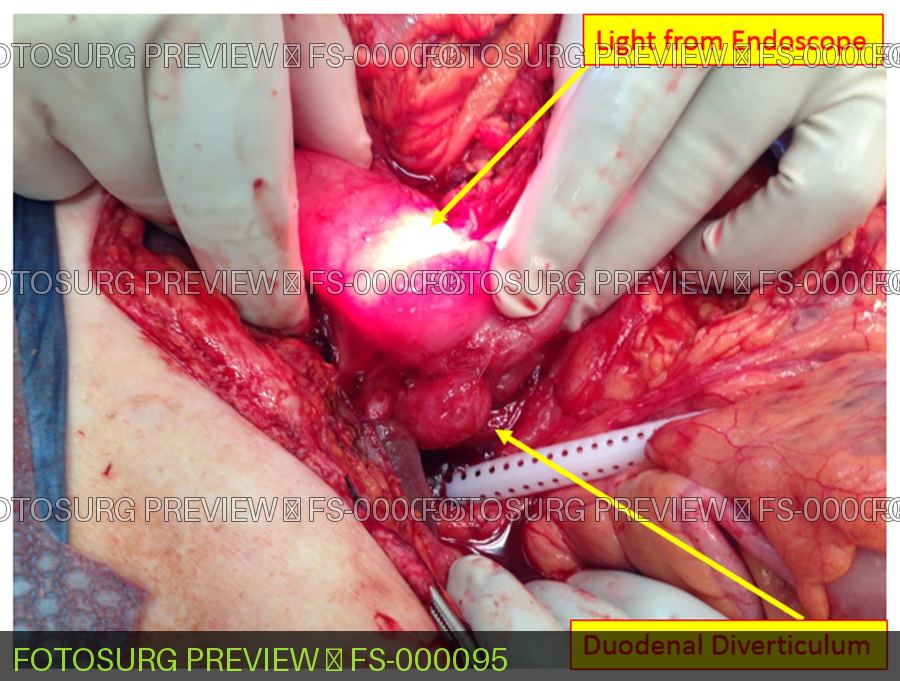 Duodenal diverticulum
