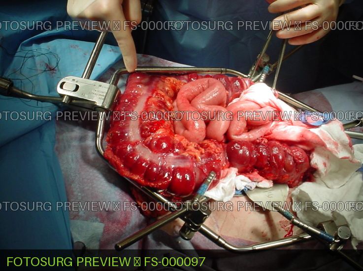 Toxic Megacolon 2
