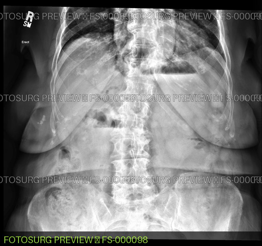 Pneumobilia