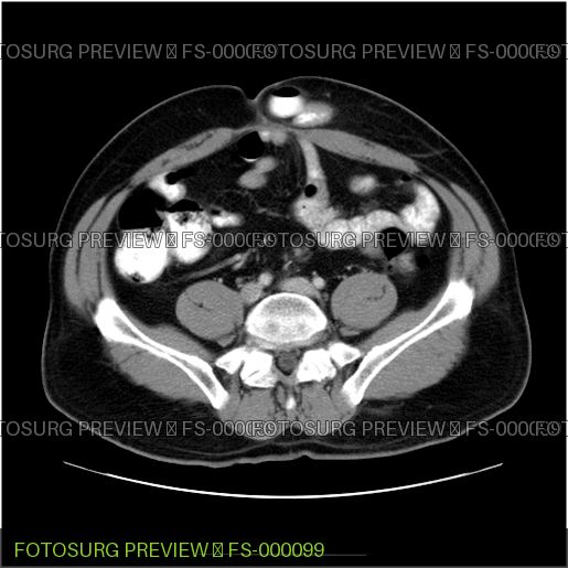 Ventral Richter hernia