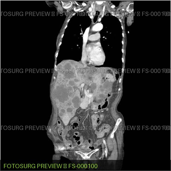 Malignant liver tumor