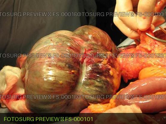 Cecal Volvulus with necrosis