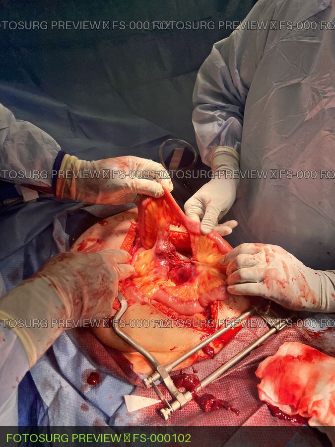 Bucket Handle Bowel Injury