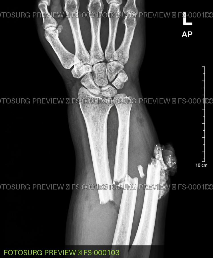 Left Arm Fracture 