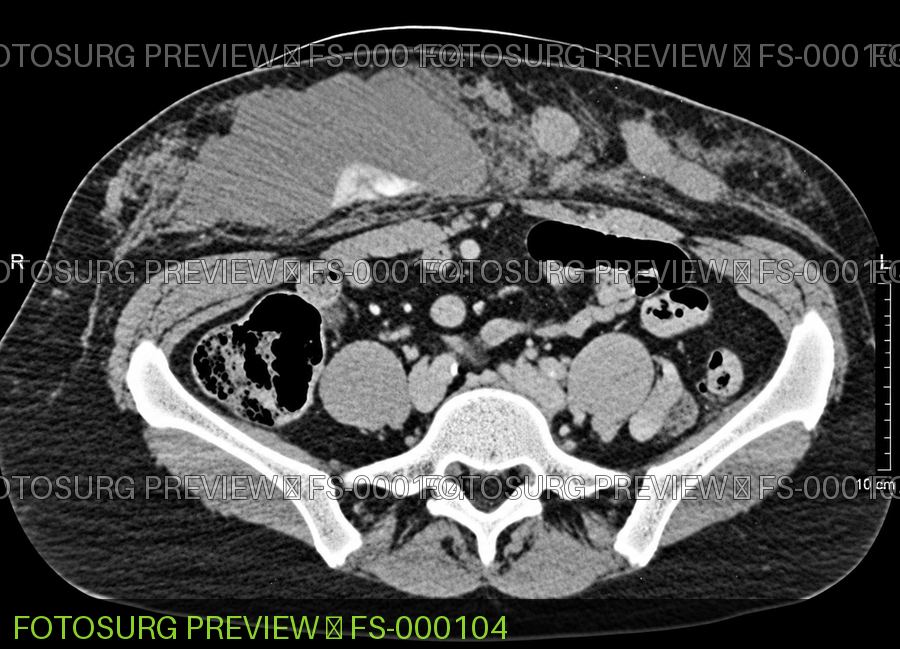 large right anterior abdominal wall/rectus sheath hematoma