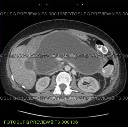 Pancreatic Pseudocyst