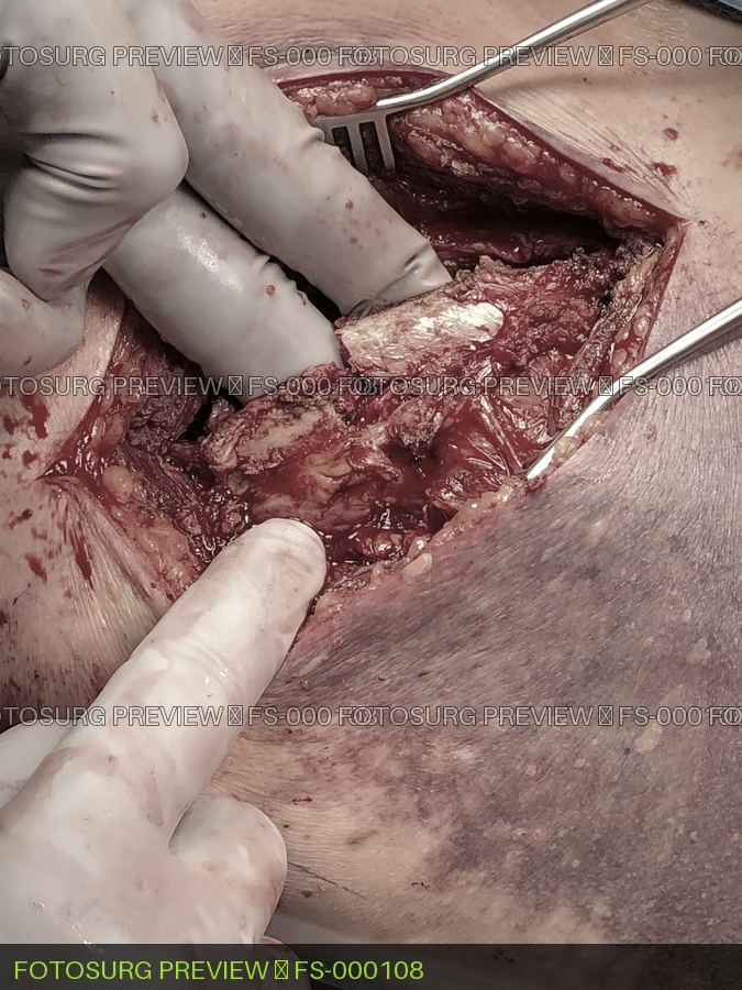 Fractured rib