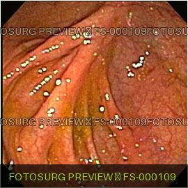 Cecum