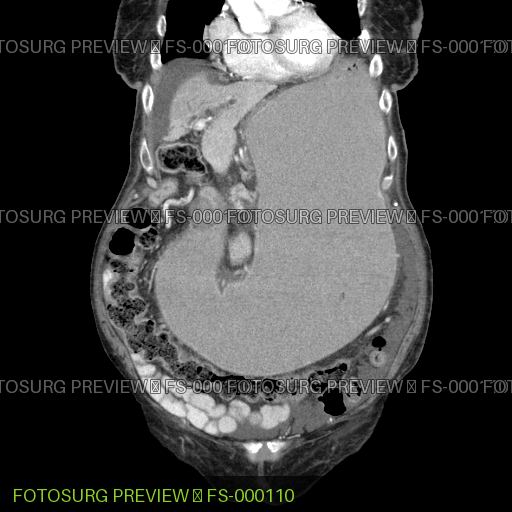 Massive Gastric Distention