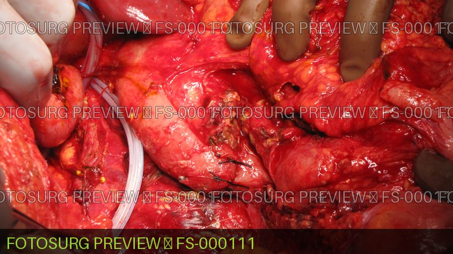 Duodenal Injury