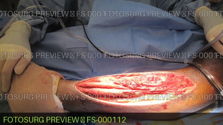 Fasciotomy