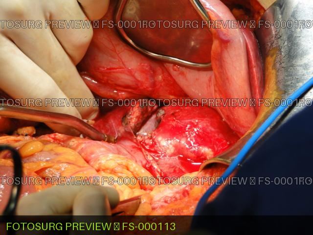 Pancreatic transection 