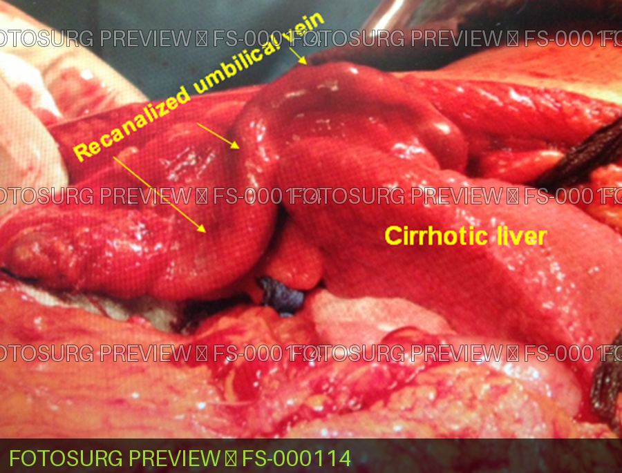 Recanalized Umbilical vein