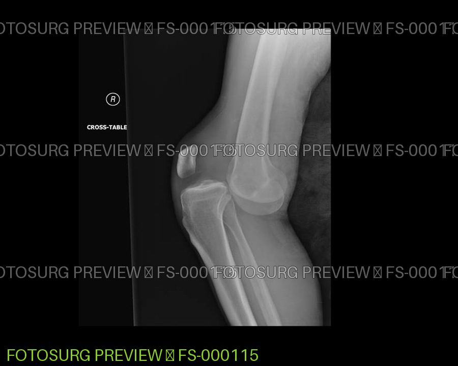 Posterior Knee Dislocation 