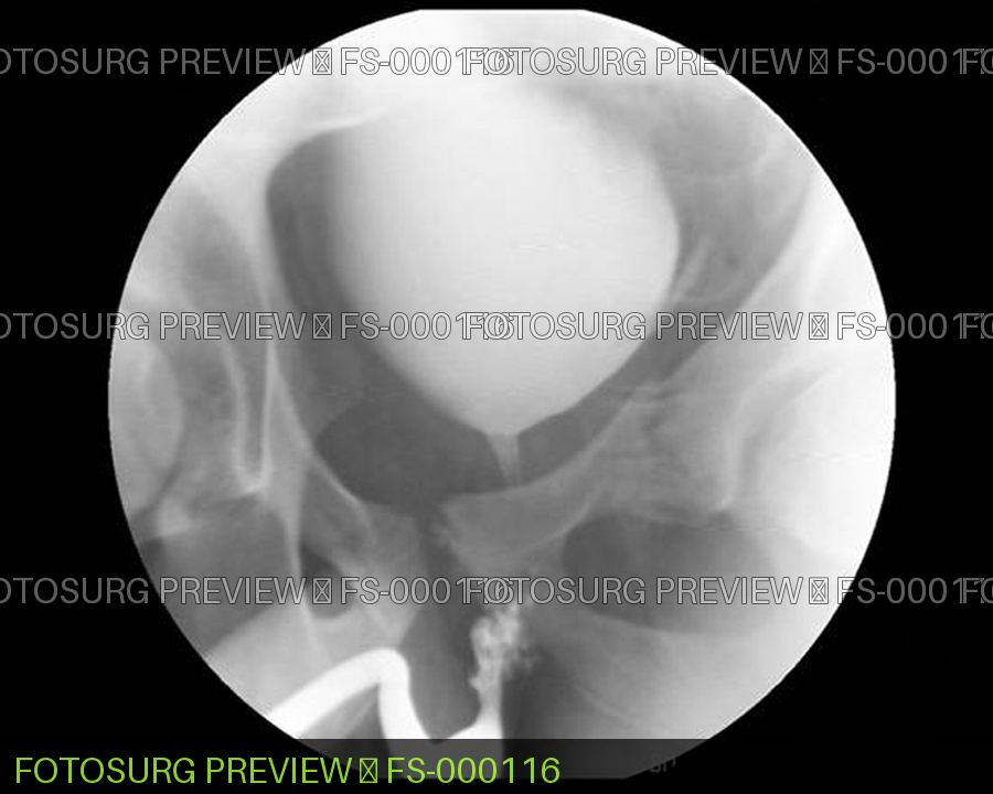 Urethral Transection 