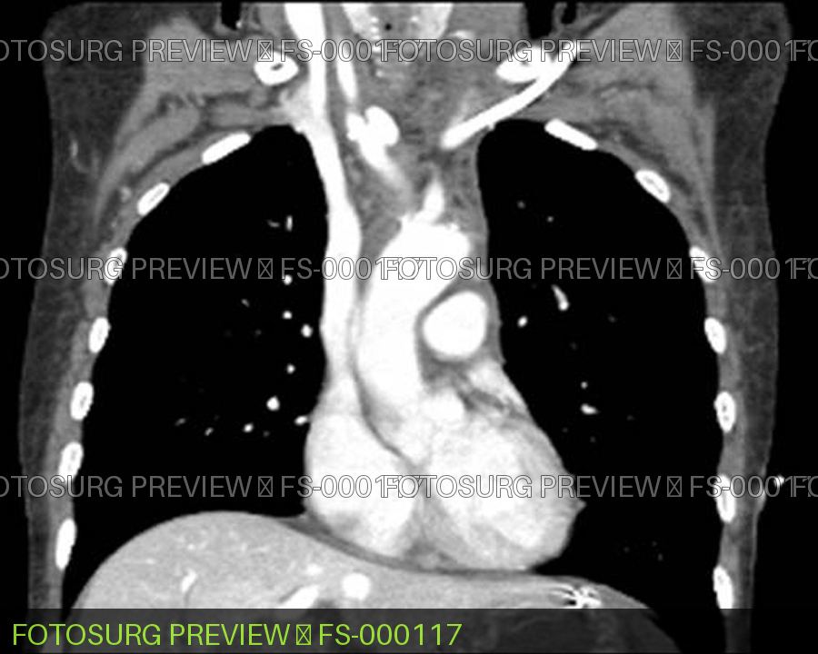 Brachiocephalic Pseudoaneurysm 