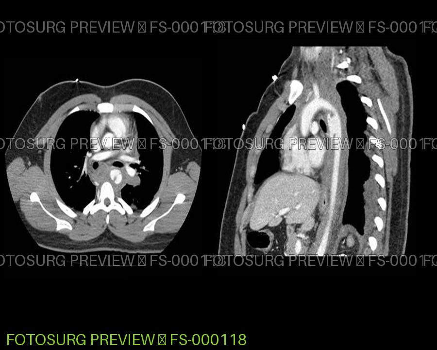 Aortic Dissection 