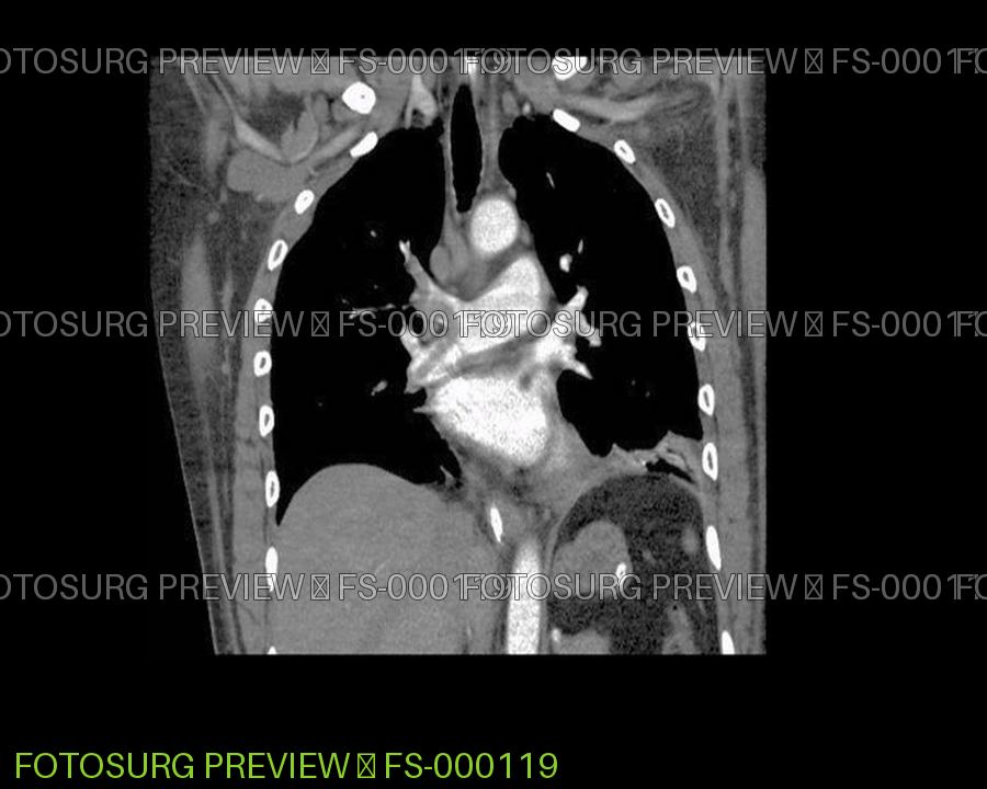 Large Pulmonary Embolism 