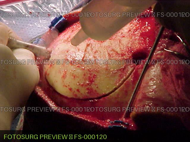 Craniotomy