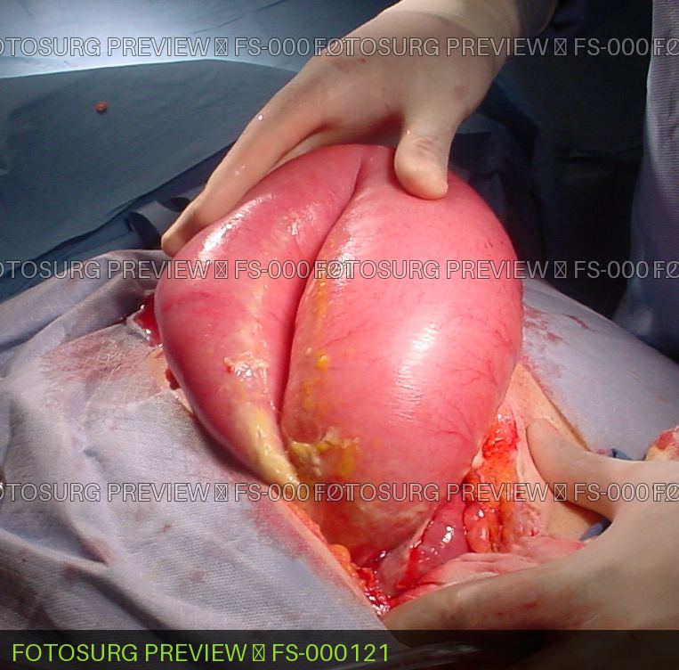 Small Bowel Obstruction with perforation 