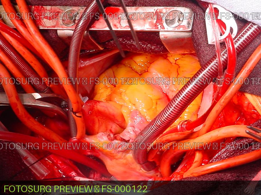 Cardiopulmonary bypass (CPB) circuit