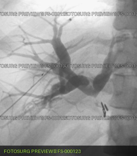 Common Bile Duct injury