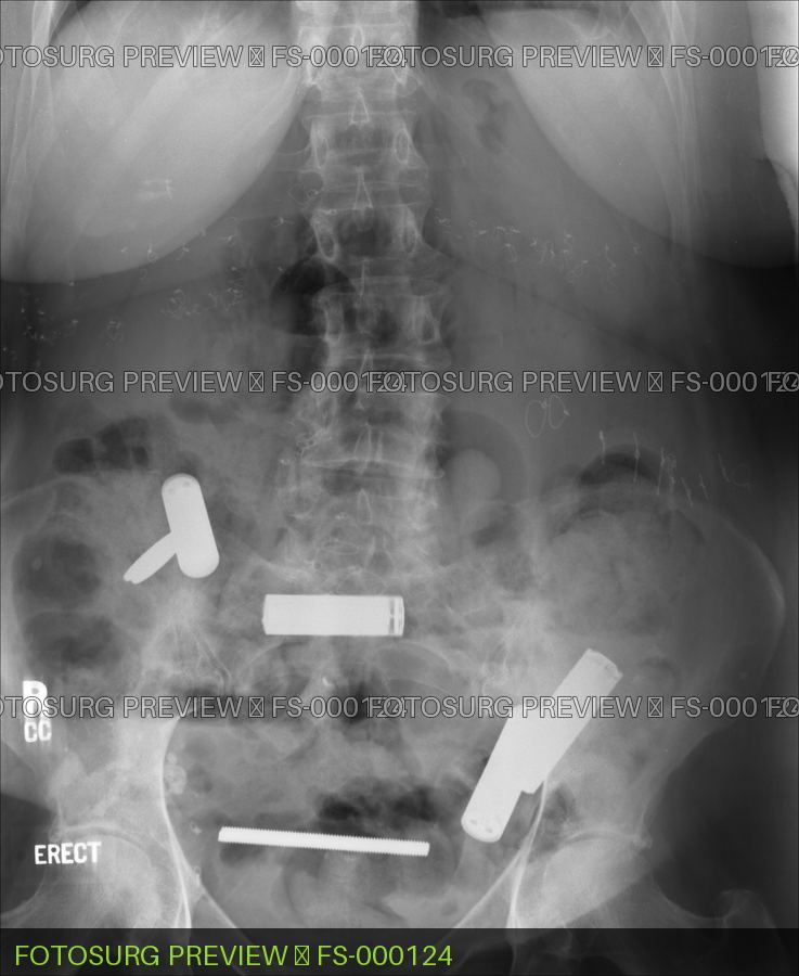Battery Ingestion 